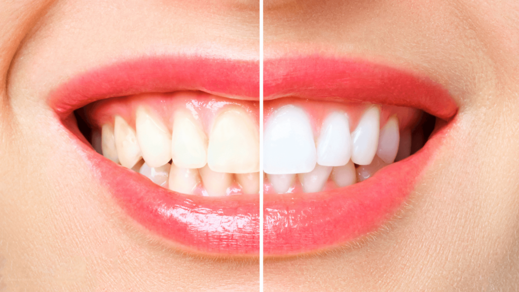 Blanqueamiento dental