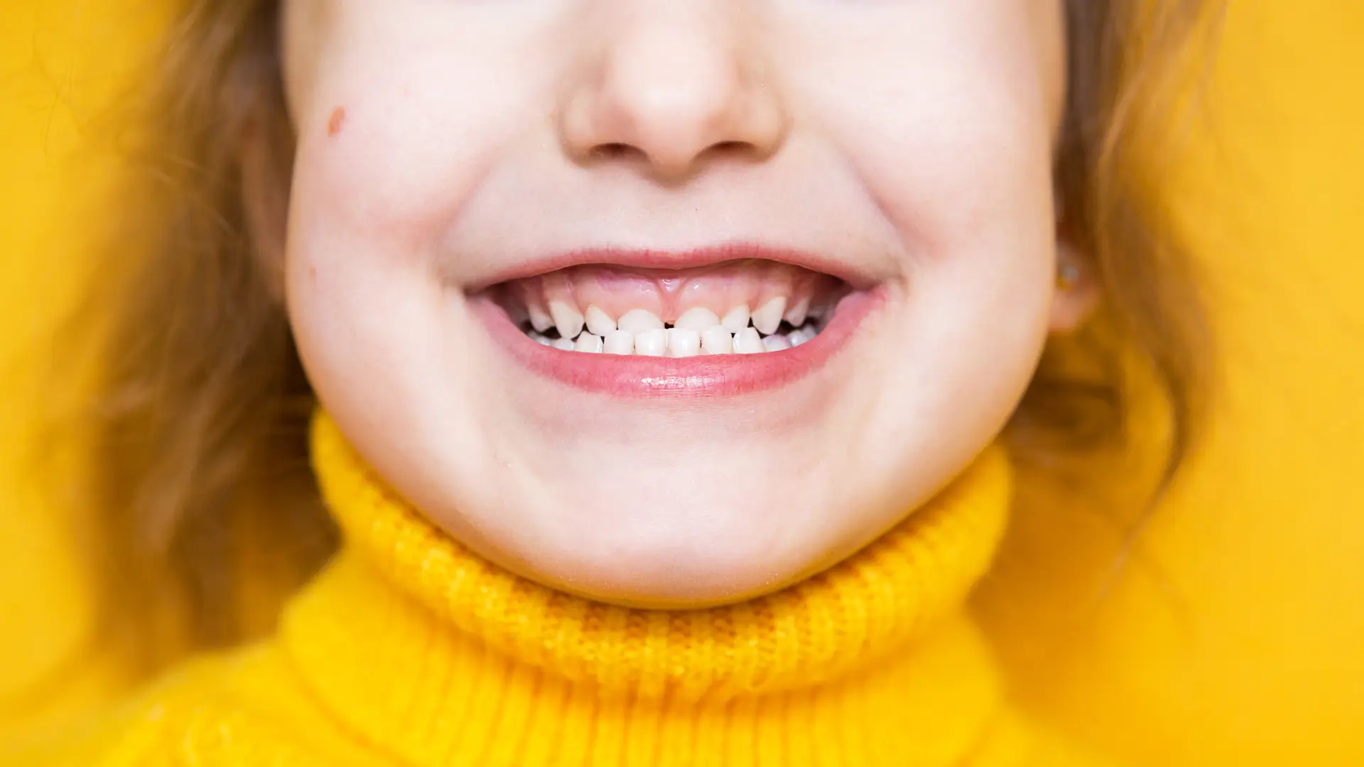 Niña con mordida invertida. Ortodoncia infantil